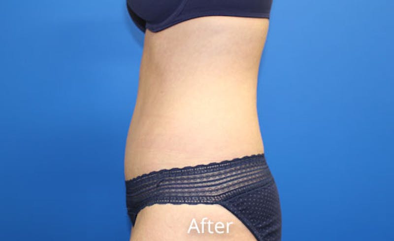 Abdominoplasty Before & After Gallery - Patient 420376 - Image 6