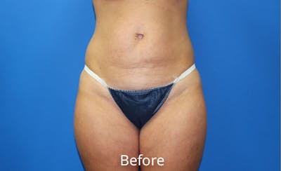 Abdominoplasty Before & After Gallery - Patient 420376 - Image 1