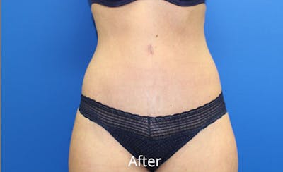 Abdominoplasty Before & After Gallery - Patient 420376 - Image 2