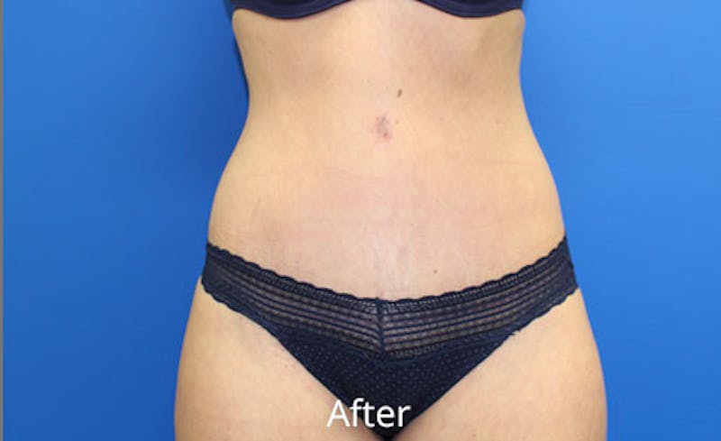 Abdominoplasty Before & After Gallery - Patient 420376 - Image 2