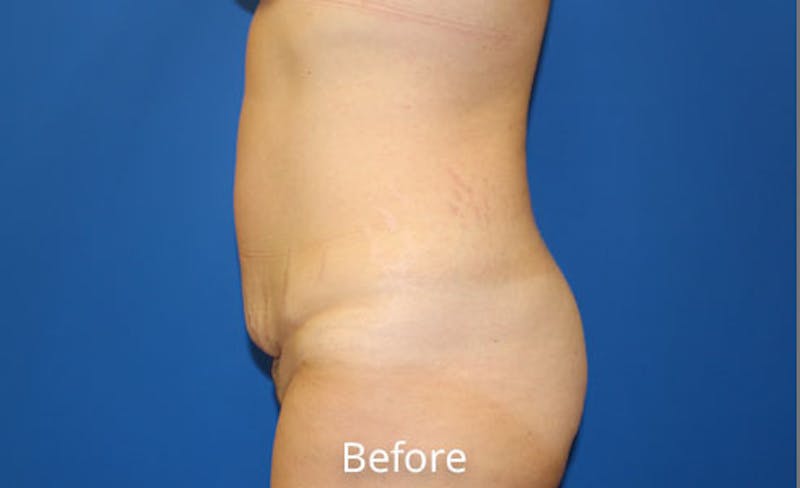 Abdominoplasty Before & After Gallery - Patient 212464 - Image 3