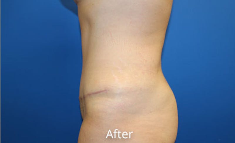 Abdominoplasty Before & After Gallery - Patient 212464 - Image 4