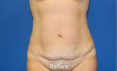 Abdominoplasty Before & After Gallery - Patient 212464 - Image 1