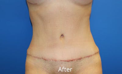 Abdominoplasty Before & After Gallery - Patient 212464 - Image 2
