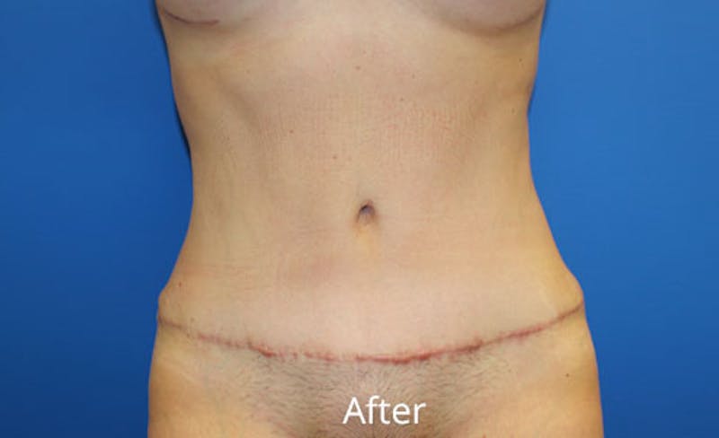 Abdominoplasty Before & After Gallery - Patient 212464 - Image 2