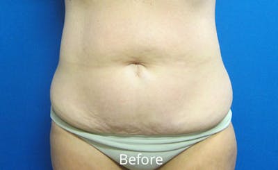Abdominoplasty Before & After Gallery - Patient 412214 - Image 1