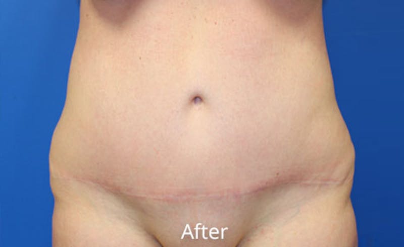 Abdominoplasty Before & After Gallery - Patient 412214 - Image 2