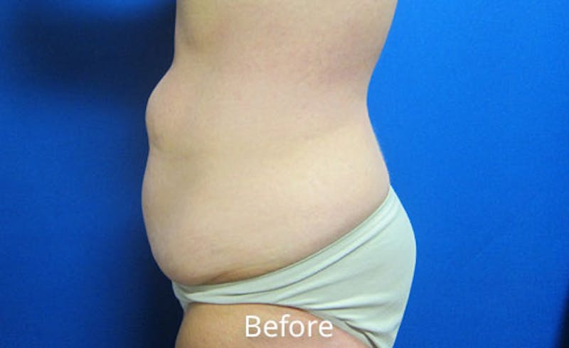 Abdominoplasty Before & After Gallery - Patient 412214 - Image 3