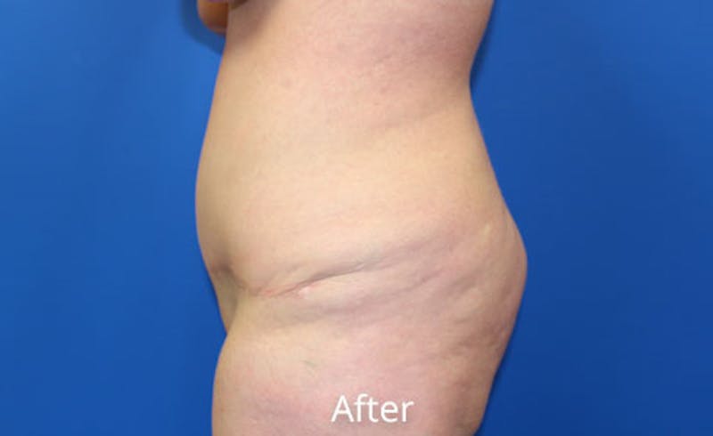 Abdominoplasty Before & After Gallery - Patient 412214 - Image 4