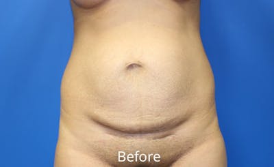 Abdominoplasty Before & After Gallery - Patient 454099 - Image 1