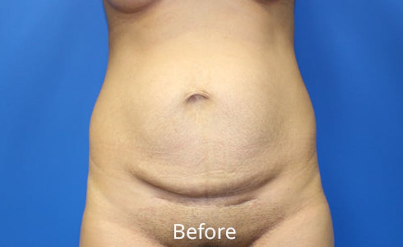 Abdominoplasty Before & After Gallery - Patient 454099 - Image 1