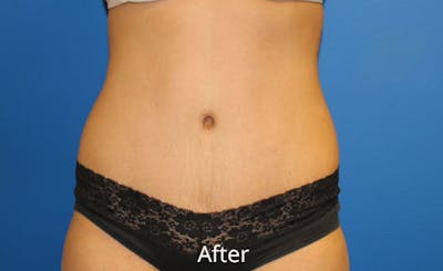 Abdominoplasty Before & After Gallery - Patient 454099 - Image 2