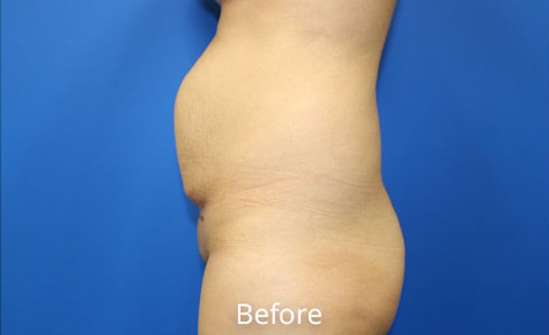 Abdominoplasty Before & After Gallery - Patient 454099 - Image 3