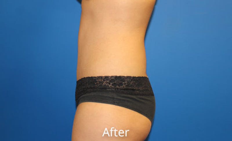 Abdominoplasty Before & After Gallery - Patient 454099 - Image 4