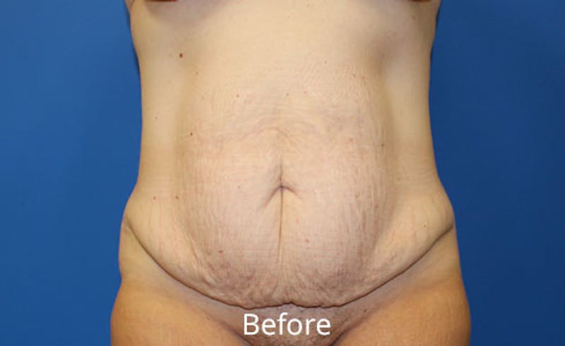 Abdominoplasty Before & After Gallery - Patient 518853 - Image 1