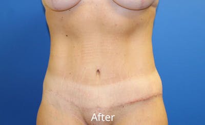 Abdominoplasty Before & After Gallery - Patient 518853 - Image 2