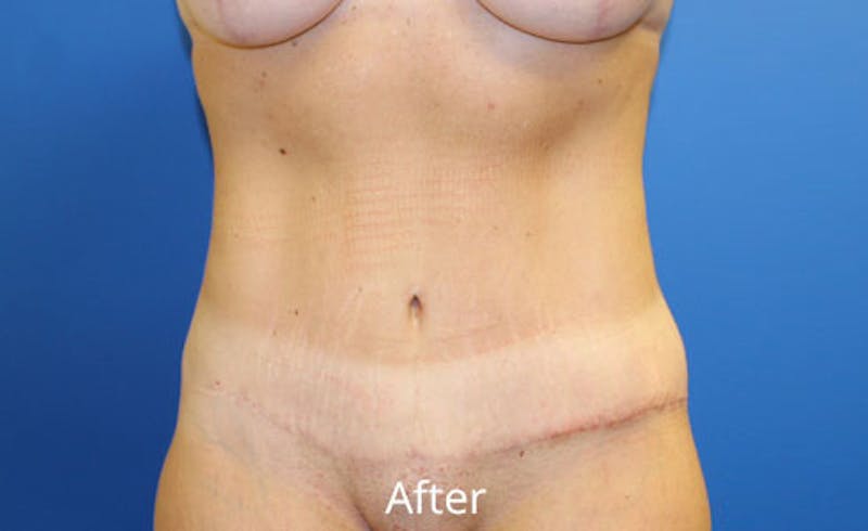 Abdominoplasty Before & After Gallery - Patient 518853 - Image 2