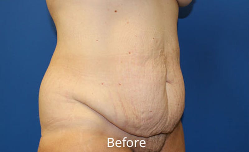 Abdominoplasty Before & After Gallery - Patient 518853 - Image 3