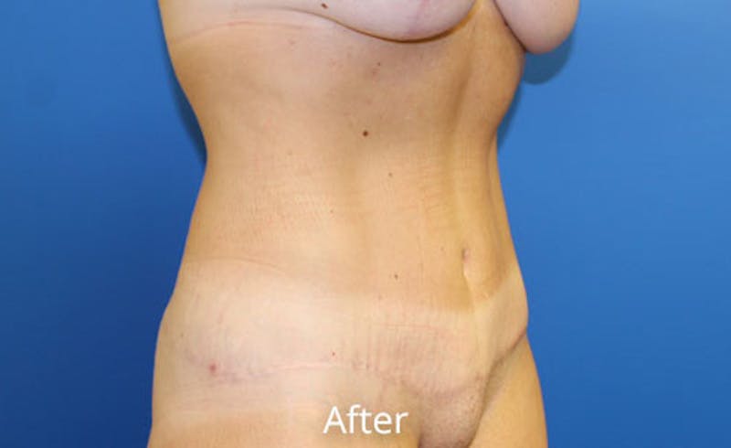 Abdominoplasty Before & After Gallery - Patient 518853 - Image 4