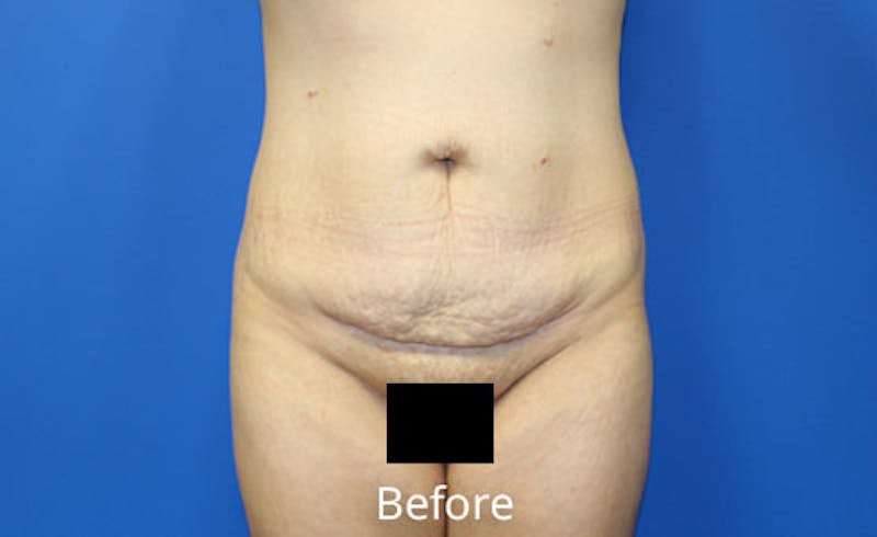 Abdominoplasty Before & After Gallery - Patient 314482 - Image 1