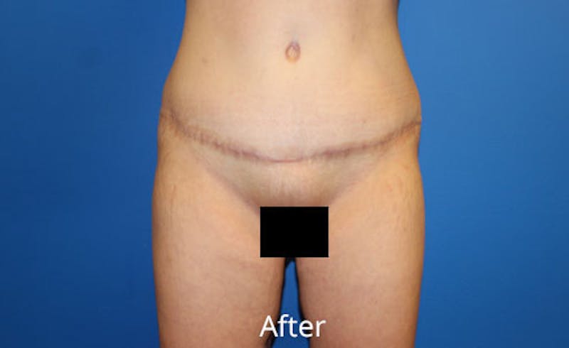 Abdominoplasty Before & After Gallery - Patient 314482 - Image 2
