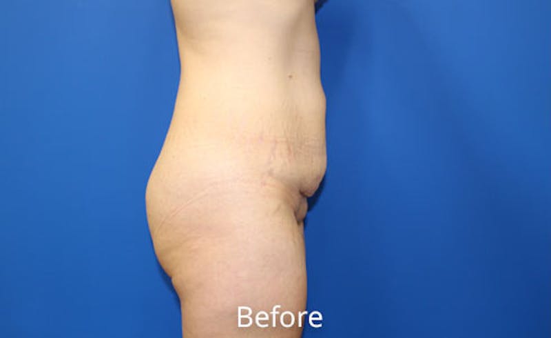 Abdominoplasty Before & After Gallery - Patient 314482 - Image 3