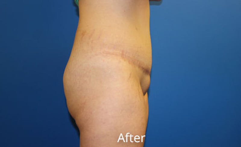 Abdominoplasty Before & After Gallery - Patient 314482 - Image 4