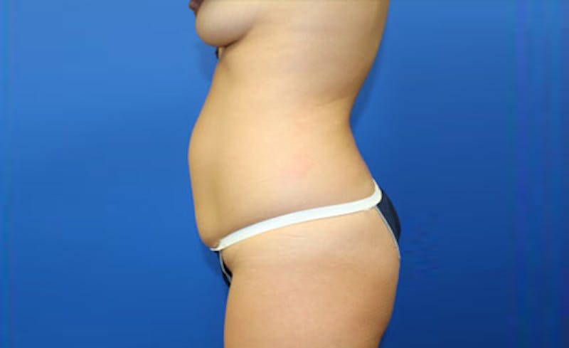 Abdominoplasty Before & After Gallery - Patient 173702 - Image 3