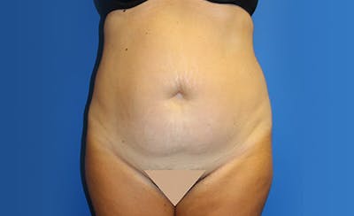 Abdominoplasty Before & After Gallery - Patient 367015 - Image 1