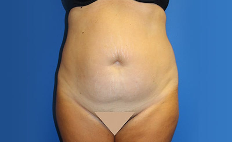 Abdominoplasty Before & After Gallery - Patient 367015 - Image 1