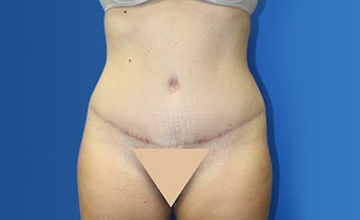 Abdominoplasty Before & After Gallery - Patient 367015 - Image 2