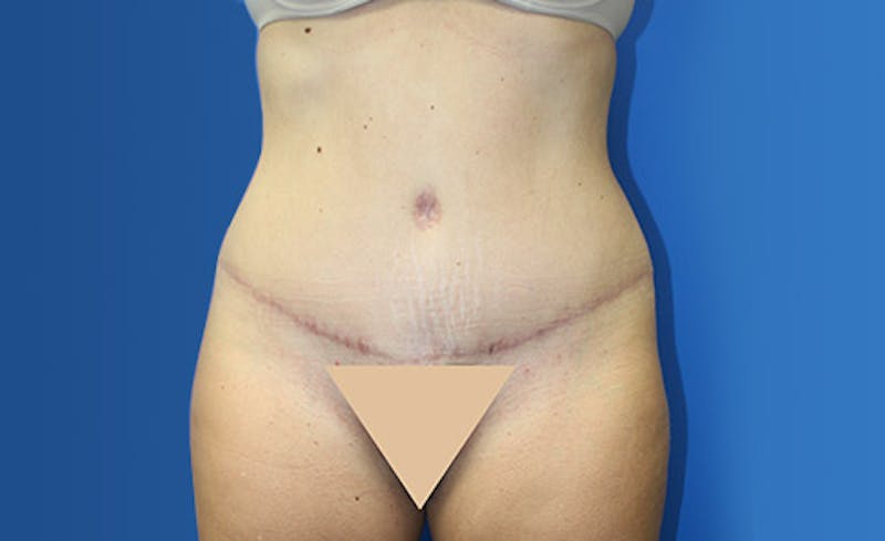 Abdominoplasty Before & After Gallery - Patient 367015 - Image 2