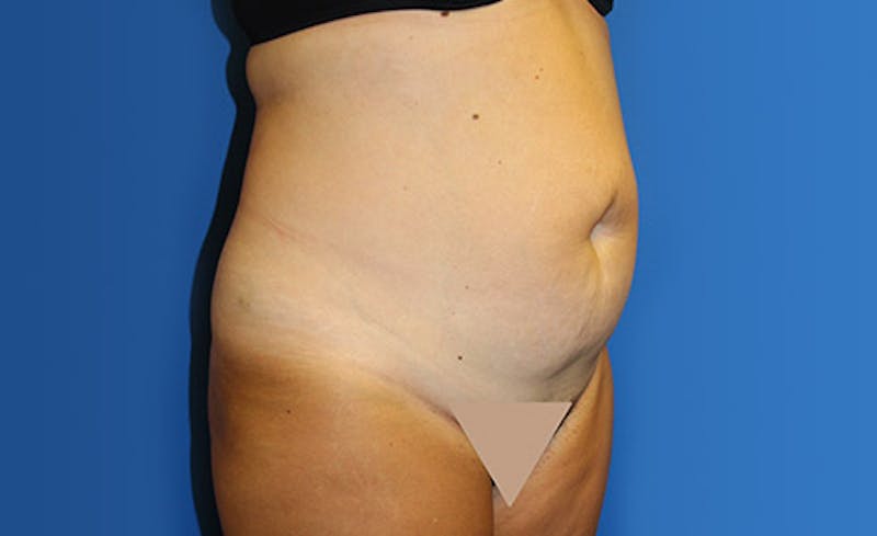 Abdominoplasty Before & After Gallery - Patient 367015 - Image 3