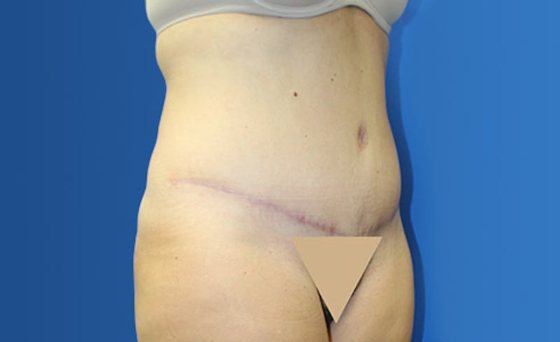 Abdominoplasty Before & After Gallery - Patient 367015 - Image 4