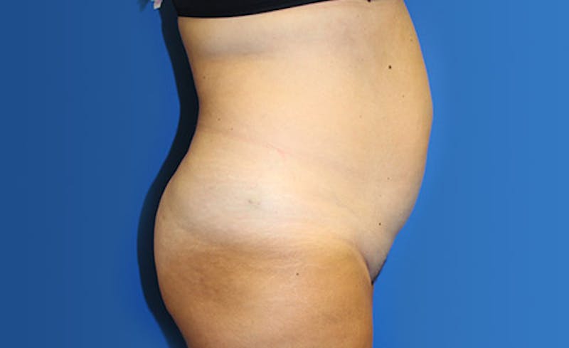 Abdominoplasty Before & After Gallery - Patient 367015 - Image 5