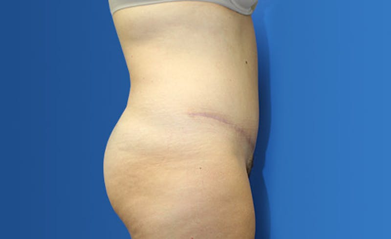 Abdominoplasty Before & After Gallery - Patient 367015 - Image 6