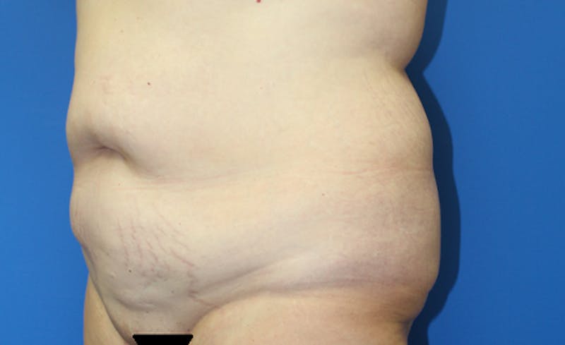 Abdominoplasty Before & After Gallery - Patient 286031 - Image 3