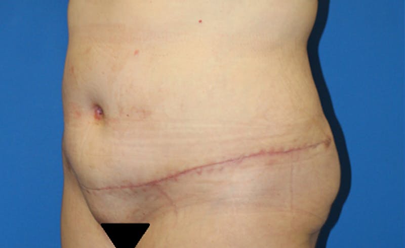 Abdominoplasty Before & After Gallery - Patient 286031 - Image 4