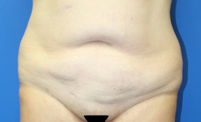 Abdominoplasty Before & After Gallery - Patient 286031 - Image 1