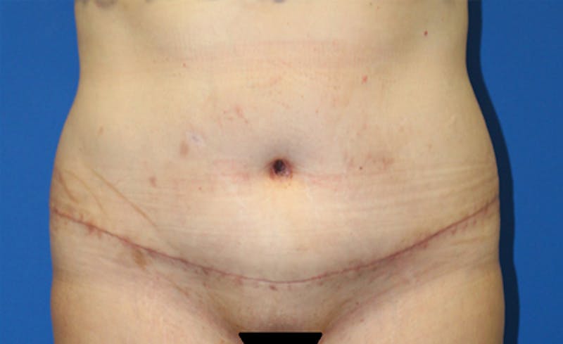 Abdominoplasty Before & After Gallery - Patient 286031 - Image 2