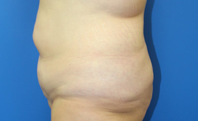 Abdominoplasty Before & After Gallery - Patient 286031 - Image 5