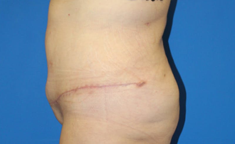 Abdominoplasty Before & After Gallery - Patient 286031 - Image 6