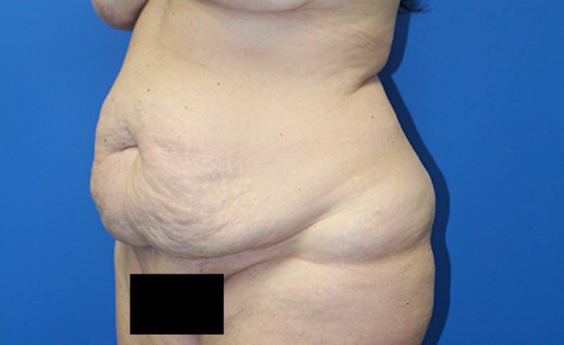 Abdominoplasty Before & After Gallery - Patient 378649 - Image 3