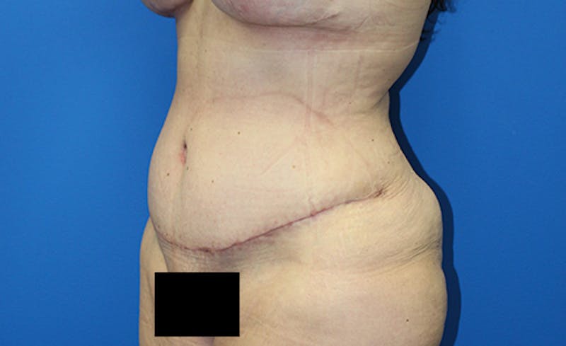 Abdominoplasty Before & After Gallery - Patient 378649 - Image 4