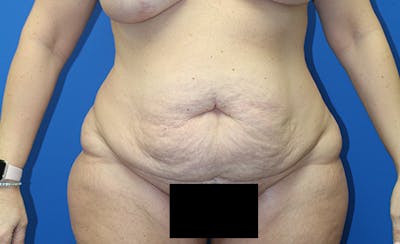Abdominoplasty Before & After Gallery - Patient 378649 - Image 1