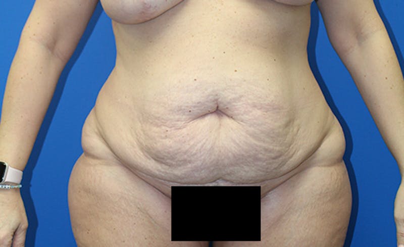 Abdominoplasty Before & After Gallery - Patient 378649 - Image 1