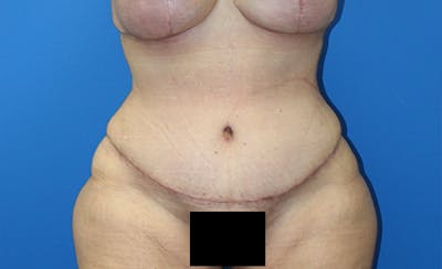 Abdominoplasty Before & After Gallery - Patient 378649 - Image 2