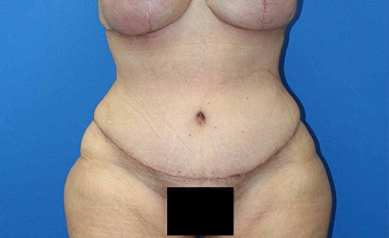 Abdominoplasty Before & After Gallery - Patient 378649 - Image 2