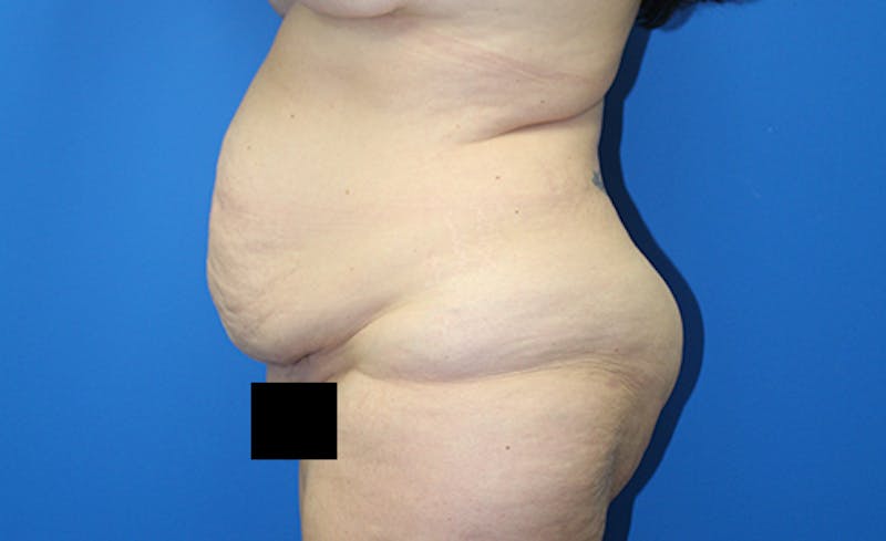 Abdominoplasty Before & After Gallery - Patient 378649 - Image 5