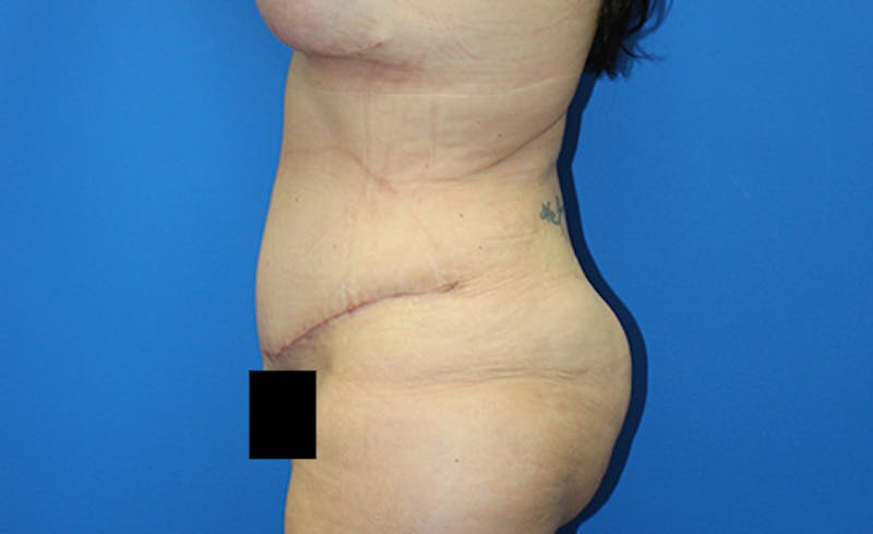 Abdominoplasty Before & After Gallery - Patient 378649 - Image 6